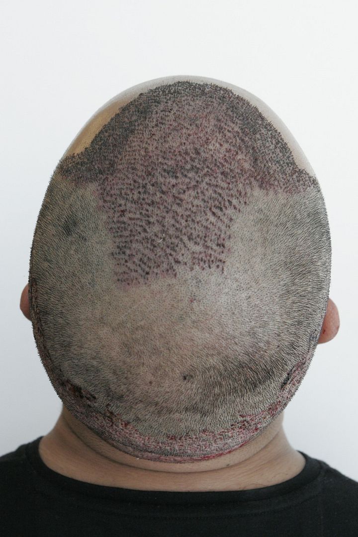 International Hair Loss Forum - Dr. ILKER APAYDIN FUE 3478 International Hair Loss Forum - Dr. ILKER APAYDIN FUE 3478