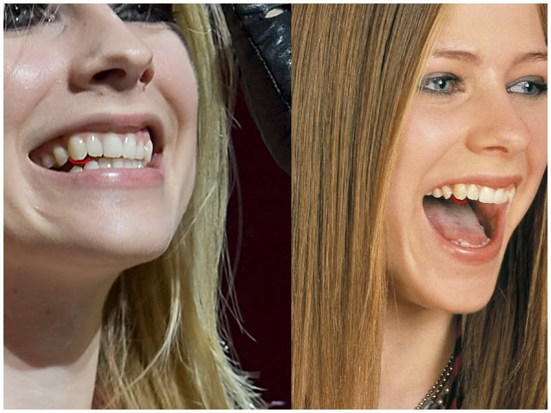 Avril Fixed her Teeth! - Page 3 - Avril Lavigne Bandaids: The Best Damn